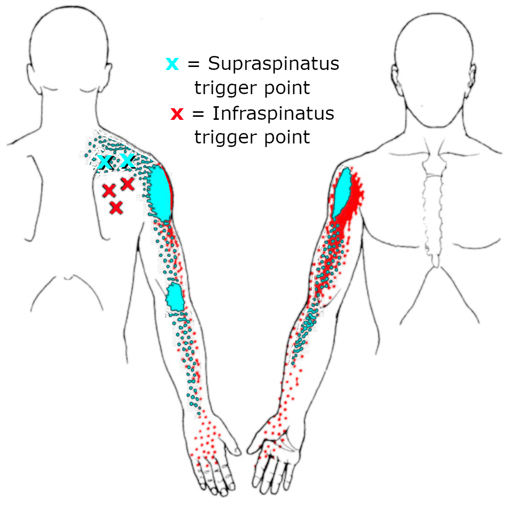 Supraspinatus-and-infraspinatus-trigger-points te behandelen met de sylo-pen