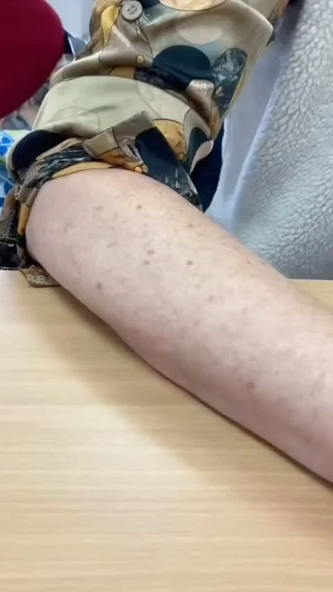De Sylo-pen: voor soepele fascie! 

Wist je dat de Sylo-pen helpt om verklevingen in de fascie te behandelen? Fascie is het weefsel dat rondom spieren en net onder de huid ligt. Het speelt een belangrijke rol in hoe soepel en bewegelijk je lichaam is. 

Hoe gebruik je de Sylo-pen! 
🔸 Voel waar het weefsel stug of verkleefd aanvoelt. 
🔸 Behandel die plekken gericht, in de richting van de stugheid. 

Met de Sylo-pen maak je het weefsel weer soepel, voor minder spanning en meer bewegingsvrijheid! 

#sylopen #sytskelohof #spierpijn #fysiotherapie #pijnklachten #sport #triggerpoint #rugklachten #rugklachtenverminderen #fysioterapeut #fysio #holistichealth #natuurlijkgezond
#neuropathie #massagetherapy #pijnvrij #artrose #bindweefselmassage
