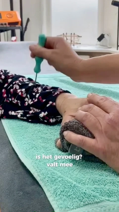 Meer grip op je handen met de Sylo-pen!

Heb je last van artrose in je vingers? Vooral in de DIP- en PIP-gewrichten (de knobbels op je vingerkootjes) kan dit veel ongemak geven. Knijpen, grijpen of een vuist maken wordt steeds lastiger.

Met de Sylo-pen stimuleer je de doorbloeding in je spieren en pezen, waardoor de spanning in je hand vermindert. Dit helpt je vingers soepeler te bewegen en kan verlichting geven bij pijn en stijfheid. Zo kun je weer meer grip krijgen op jouw dagelijkse activiteiten! 

De DIP- en PIP-gewrichten zijn gewrichten in je vingers:

🔹 DIP-gewricht (Distale Interfalangeale gewricht)
Dit is het gewricht het dichtst bij je vingertop, tussen het laatste en het middelste vingerkootje.

🔹 PIP-gewricht (Proximale Interfalangeale gewricht)
Dit is het middelste vingergewricht, tussen het eerste en tweede kootje van je vinger.

Deze gewrichten kunnen door artrose verdikken en pijnlijk worden, waardoor je vingers stijf aanvoelen en je minder goed kunt knijpen of een vuist kunt maken. De Sylo-pen kan helpen door de doorbloeding te stimuleren en de spieren en pezen rondom deze gewrichten te ontspannen.

Wanneer je pijn hebt in je handen, dan moet je ook de onderarm behandelen met de Sylo-pen! 

Heb jij ervaring met de Sylo-pen voor je handen? Laat het ons weten! 👇

#SyloPen #Sytskelohof #Artrose #HandArtrose #artrosis #Pijnverlichting #Pijnklachten #Pijnvrij #Handpijn #Mobiliteit #Fysiotherapie #Fysiotherapeut #Fysio #Gezond #Gezondheid #Handtherapie #Spierpijn #Gezondeleefstijl #Triggerpoints #Natuurlijkgezond #Bindweefselmassage #Doorbloeding #Reuma